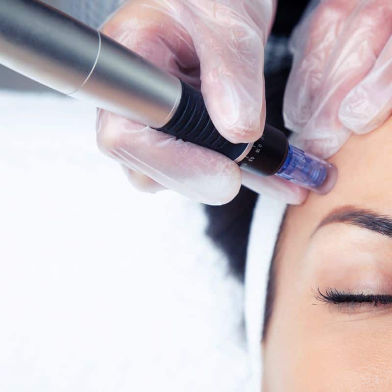 Morpheus8 treatment Rayleigh from Lipo Sculpt - Book in today!